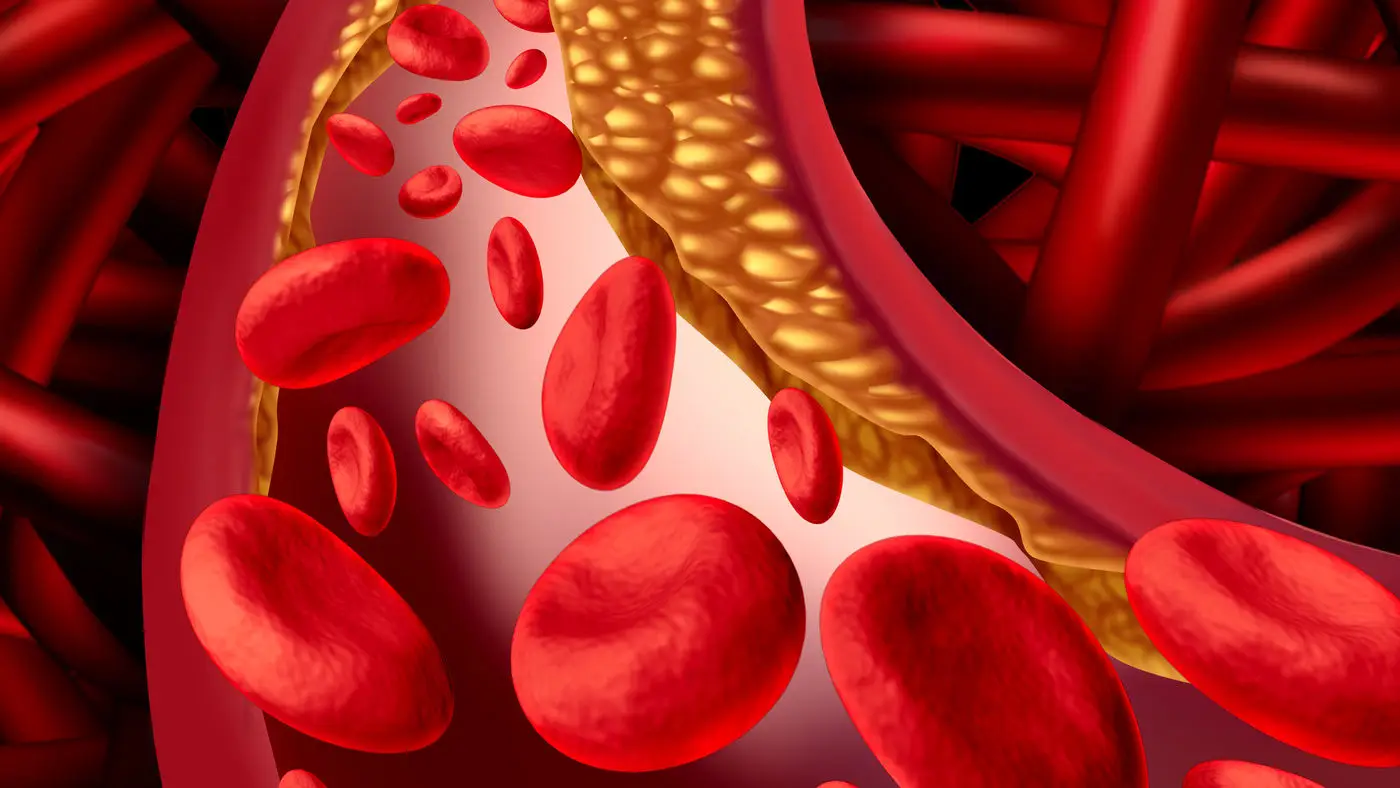 Colesterolo alto: cosa succede se mangi formaggi tutti i giorni